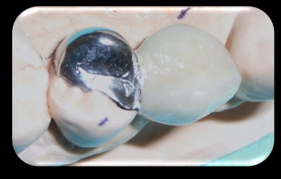 Palatal preparation is minimal along with