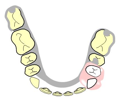 Denture Design Lower Denture Rests LL7 distally (within amalgam restoration) LL5 mesially (within amalgam restoration) LR7 distally Clasps Occlusally approaching clasp LL6 and LR7 Connectors Major