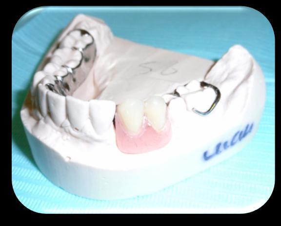 Rest seats were incorporated on the LL6 and LR7 for tooth support. Occlusally approaching clasps were used to engage the natural buccal undercut on the LR7 and LL6.
