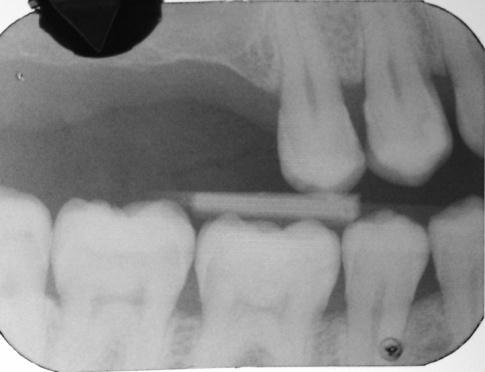 distal D2, UR5 mesial D2 UL6 Distal deficiency - monitor LL8 UL6 is clinically sound, monitor.