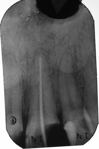 Working Length Radiograph Type of Radiograph: Working Length Radiograph for UL1 endodontic treatment Normal UR1 mesial D3, UL1 mesially slightly into enamel (decided to monitor) UL2 slight mesial