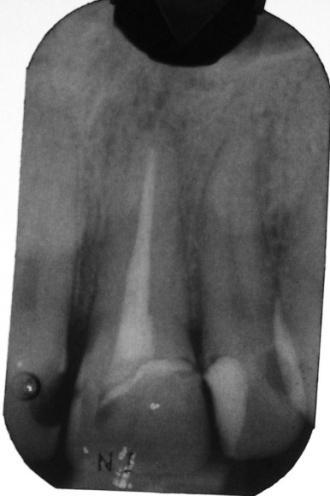 Post Operative Endodontic Radiograph Type of Radiograph: Post Op Radiograph for UL1 Endo Normal UR1 mesial D3, UL1 mesially slightly into enamel (decided to monitor), UL2 distal D3 UL2 slight mesial