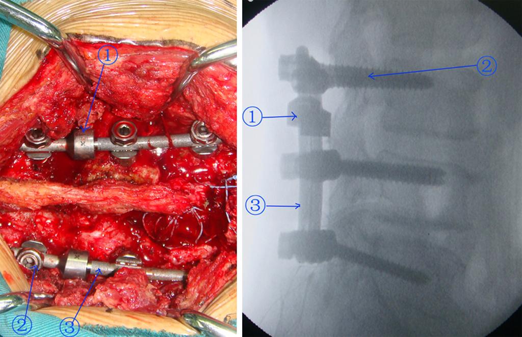 Figure 1. Images of the Isobar TTL Semi-Rigid Rod System and post-operative lateral X-rays. (1 The dynamic component (damper element); 2 The titanium alloy pedicle screw; 3 Connecting rod).