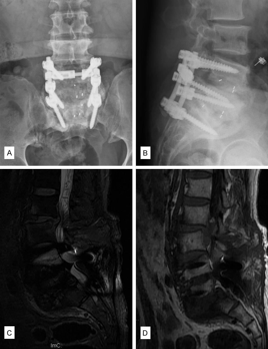 Isobar TTL system in 37 patients (stenosis in 17, disc herniation with instability in 14, and degenerative spondylolisthesis in six) and they concluded that the Isobar TTL, after microsurgical