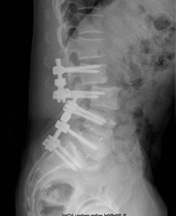 though the screw loosening, pull-out, and the fracture of the pedicles were confirmed in the third lumbar surgery, we consider this analysis as also hypothetical. Figure 5.