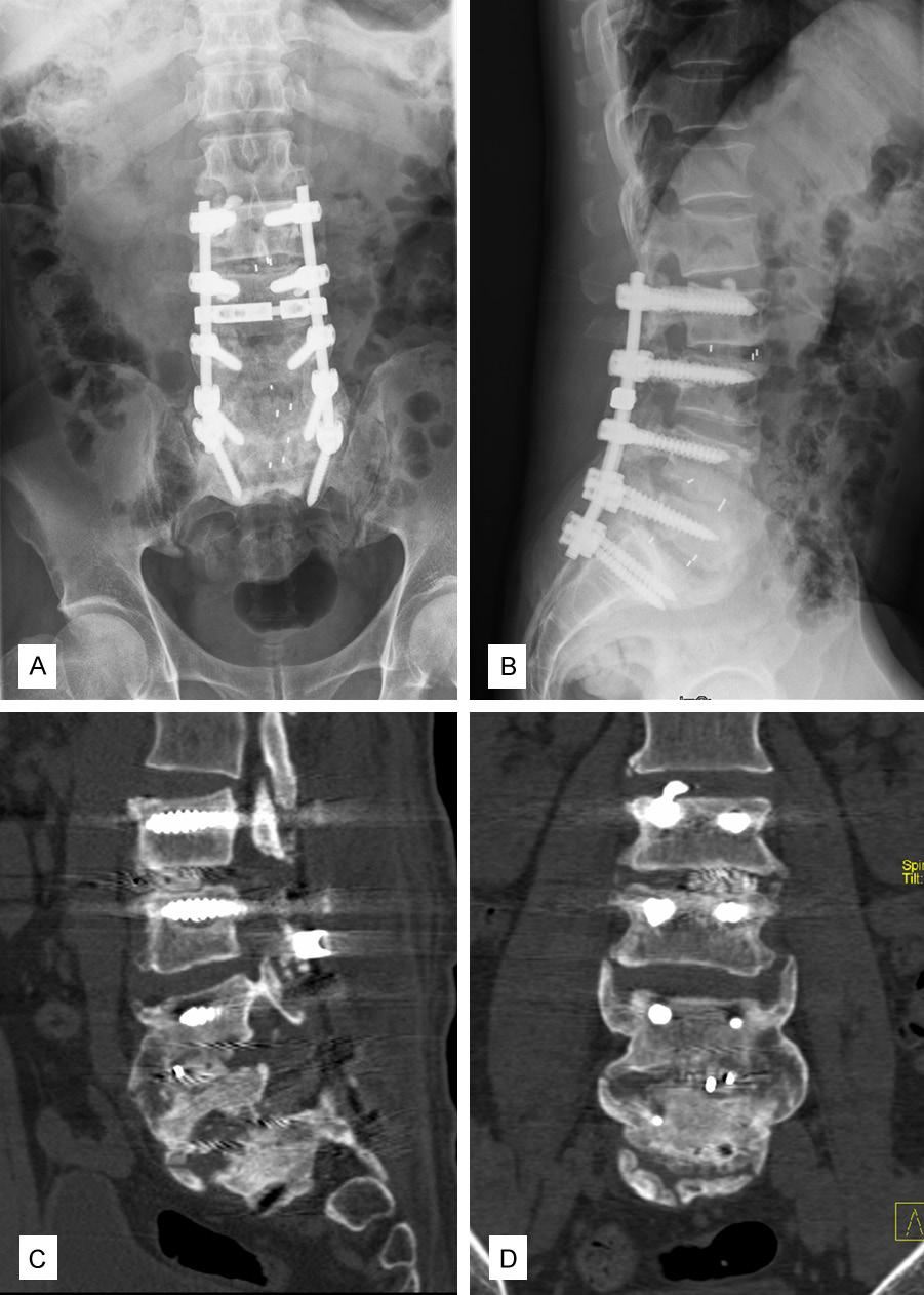 com Figure 6. Post-operative immediate (his third surgery) X-rays showed the accurate positioning of the implants and satisfactory lumbar curvature. References [1] Khoueir P, Kim KA and Wang MY.