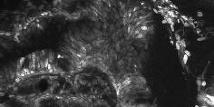 Colon Cancer Acriflavine aided Endomicroscopy Tissue and nuclei analysis
