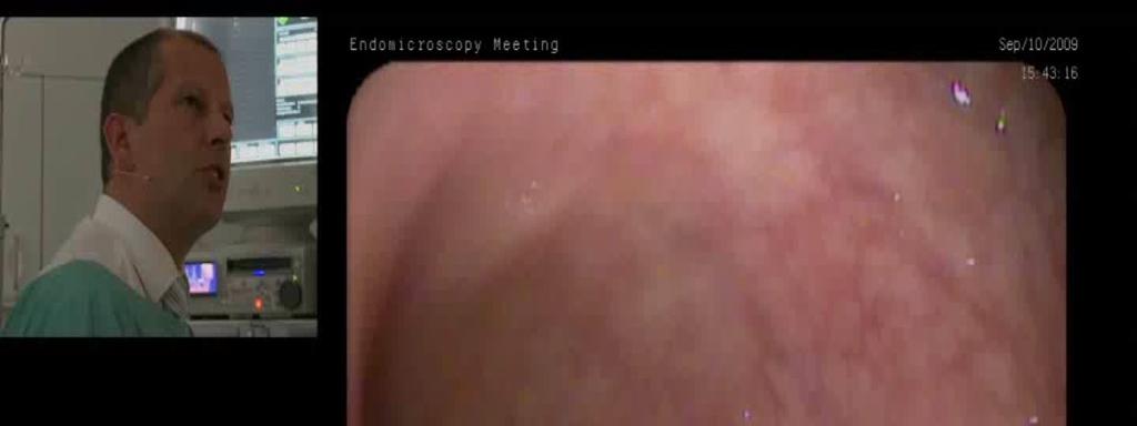 Management of polypoid dysplasia ALM= polypoid within inflamed or uninflamed mucosa Goal - Endoscopic