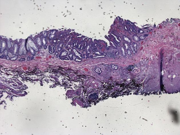 Early Cancer Low-Grade Tubulo-Glandular Adenocarcinoma (LGTGA) Develops