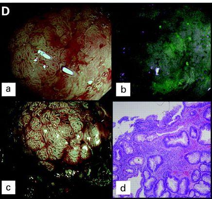 primarily detected No additional neoplasia in WLE WLE first (n = 25) 3 neoplastic lesions