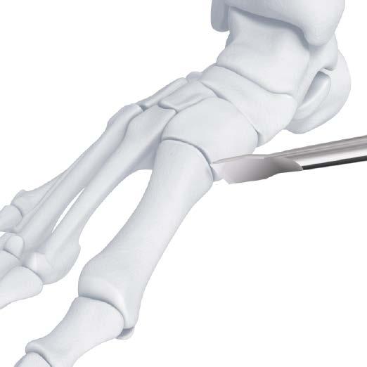 3.5 mm VA LCP Medial Column Fusion Plates 3 Prepare joint surfaces Expose and prepare all the joints for fusion. Anatomically align the tarsometatarsal axis.