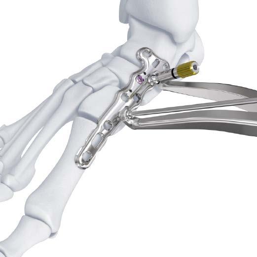 3.5 mm VA LCP Medial Column Fusion Plates b) 3.5 MM VA LCP Medial Column Fusion Plate, 95 mm, TALUS EXTENSION b 3) Compress the joint using the compression forceps.
