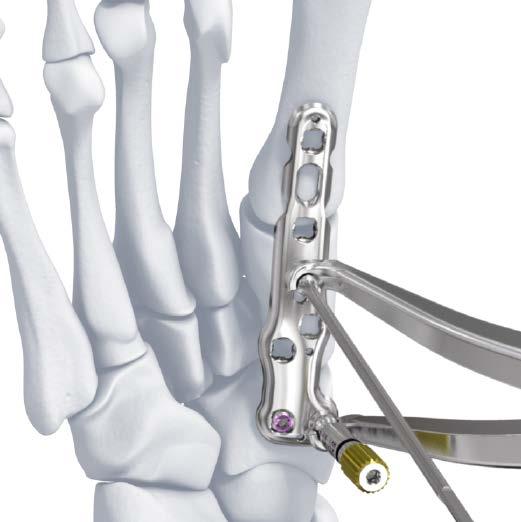 3.5 mm VA LCP Medial Column Fusion Plates c) 3.5 mm VA LCP Medial Column Fusion Plantar Plate, 78 mm c 3) Compress the joint using the compression forceps.