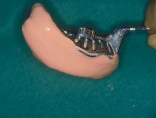 Severely resorbed jaw A lot or room between arch and tray A great deal of impression material required Stiff alginate recommended So in case of a severely resorbed jaw, there is a