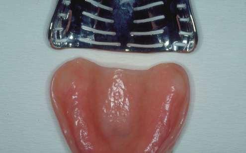 You then choose for the upper denture a tray that is