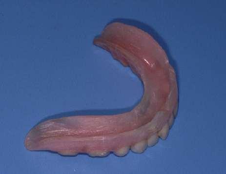 These 2 examples illustrate why. This was the loose old denture and this is the new one.