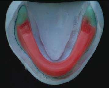 check customised tray in the mouth In other words, an impression and a model have been made based on the anatomy.