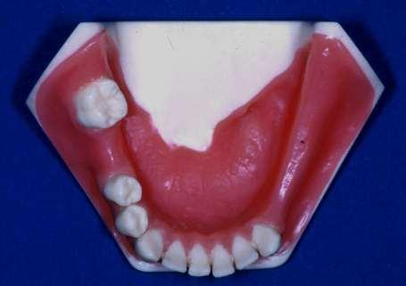 Impressions for removable partial dentures Should include: the teeth the occlusal rest seats the denture bearing tissues the lingual area What is the problem?