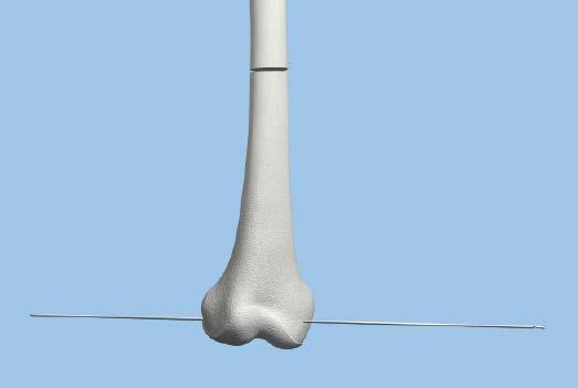 Insert a smooth wire transcondylar in the distal femur, perpendicular to the long axis of the bone.