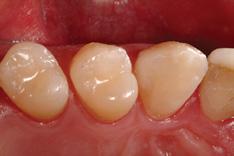restorations, sealants and quick provisional fillings.