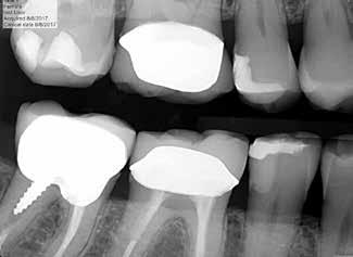 Class II Sandwich a conventional glass ionomer is placed as a first increment over the dentin followed by a bonding agent and composite.
