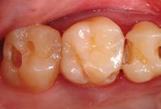 from page 28 Case 4 Class I a conventional glass ionomer is placed to restore numerous teeth quickly. Case 5 3.