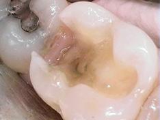 Case 6 Core Buildups after preparing the tooth a cavity conditioner is placed