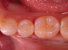 design can be used in the larger of the two cavities followed by direct access