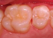 without damage to the occlusion or sound tooth structure (Case 8).