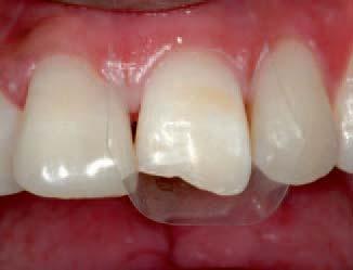 _Midline diastemata (MD) are spaces of varying magnitude between the crowns of fully erupted maxillary and mandibular central incisors. Keene describes MD as anterior midline spacing greater than 0.