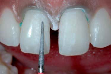 The patient had good oral health, normal function and no para-functional or other destructive oral habits.