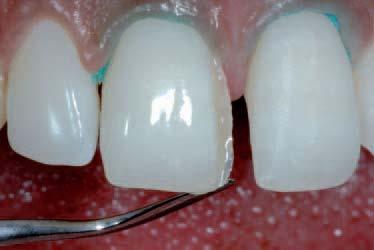 In addition, the technique is economical and the possible need for sophisticated indirect restoration can be postponed. Direct-bonding restorations demand excellent clinical skills.