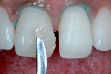 tissue responses of the materials (restoration in diastema closure normally touches the gingival tissue and sulcus).