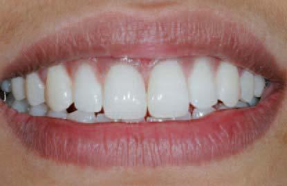 The Direct Cosmetic Restoration Kit and the Super-Snap Rainbow Technique Kit (both SHOFUInc.) were used to prepare the teeth and to finish and polish the final restorations (Figs. 7 22).