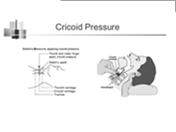 Cricoid pressure Goal: 10 minutes, from Decision to Birth