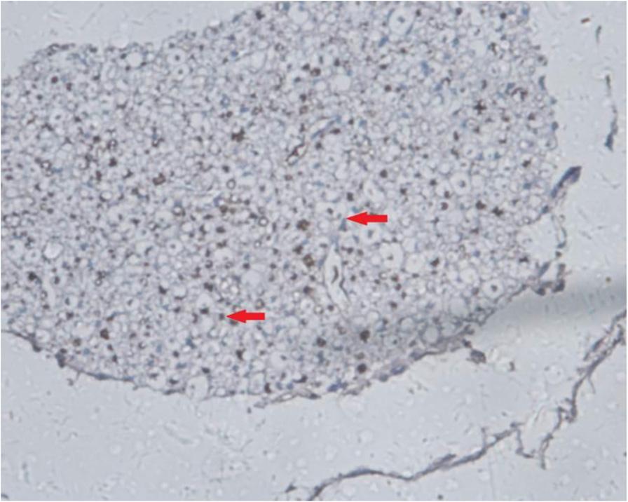 Liu et al. Journal of Orthopaedic Surgery and Research (2016) 11:6 Page 4 of 5 Fig. 4 NF 20-Gy group 14 weeks after SCI. The myelin staining is light, and part of the grid structure has ruptured.