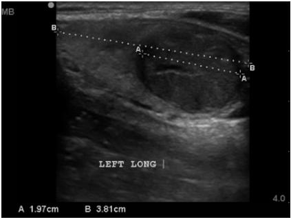 CASE 1 Exam is normal except for high normal pulse of 95 bpm. When would you order an Ultrasound of the Thyroid?
