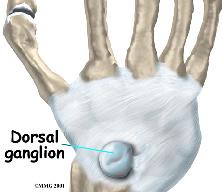 A Patient's Guide to Ganglions of the Wrist the wrist capsule are the joints themselves.