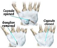 is made, but depending on the location of the ganglion, a second incision may be necessary.