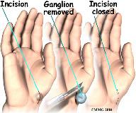 The tendons that run across the back of the wrist and into the fingers are retracted (or moved) out of the way.