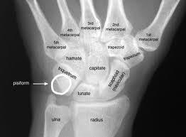 Osteology of the Wrist (Bones) cont Osteology of the Wrist (Bones) cont Ulnar