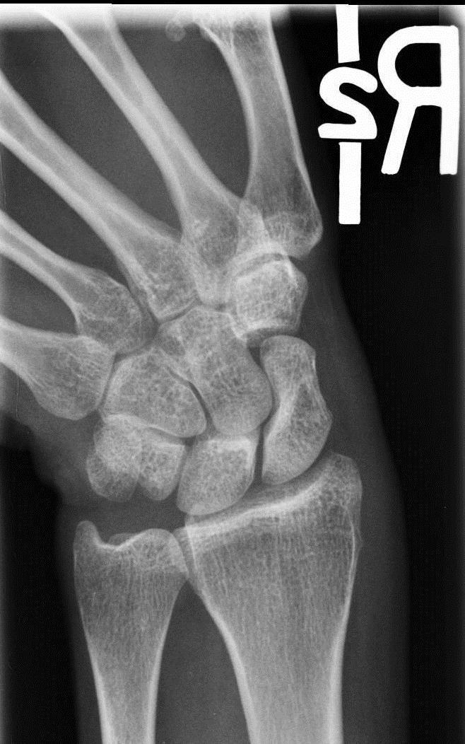 Structures Shown: Scaphoid ; carpal interspaces on ( ) side of