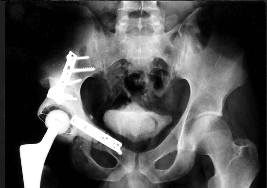 A 32-year-old woman with low-grade chondrosarcoma arising from the right ilium; (a) pre-operative X-ray showing calci cations and displacement of the right ureter, (b)