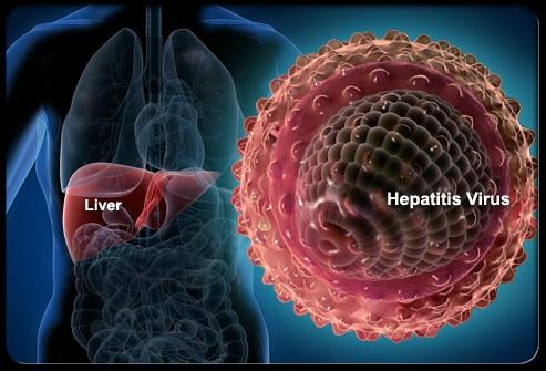 Hepatitis : A Visual Guide to Hepatitis What Is Hepatitis? Hepatitis is an inflammation of the liver. It may be caused by drugs, alcohol use, or certain medical conditions.