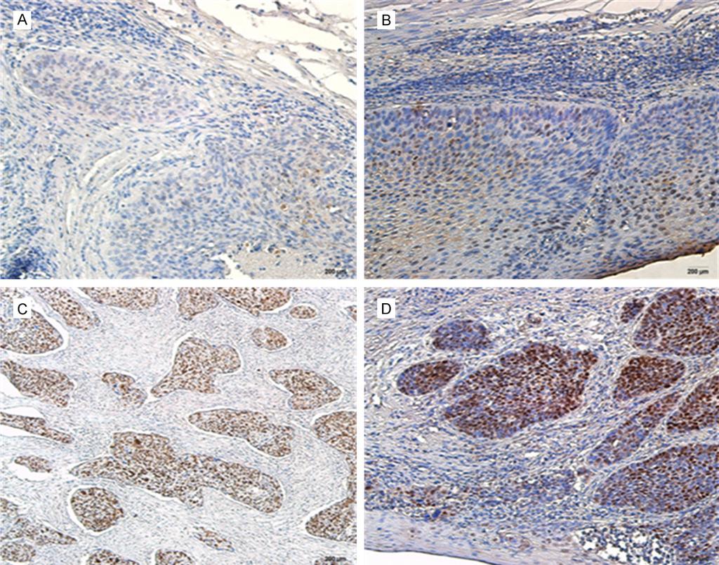 Figure 1. Immunohistochemical analysis of CREPT expression. A. Negative CREPT expression in ESCC-adjacent tissues. B. Weakly positive CREPT immunostaining in ESCC samples. C. Moderately positive CREPT immunostaining in ESCC samples.