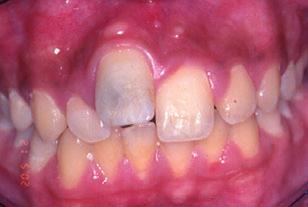 Decoronation of an ankylosed tooth 133 varies individually; there is a high risk of severe infraposition when ankylosis is diagnosed before the age of 10 or before spurt of growth.