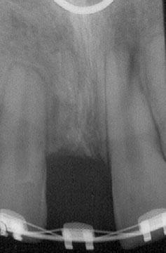incisor, and disappearance of the periodontal space. Ankylosis of the right upper central incisor was diagnosed with advanced replacement resorption.