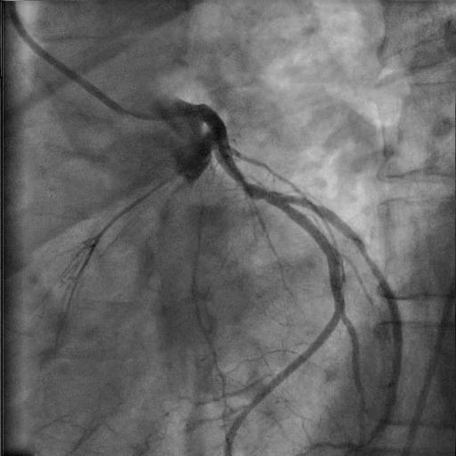 Patient Collateral vessel growth CHD Catheter