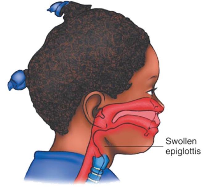 Upper or Lower Airway Infection Epiglottitis Bacterial infection of the