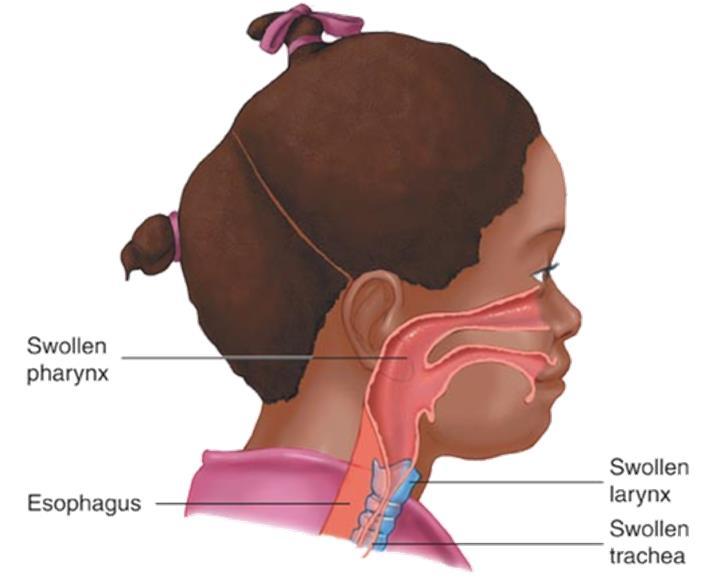 hoarse voice may be heard Croup Swelling of the whole airway Seen in